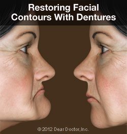 REMOVABLE DENTURES