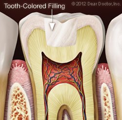 Tooth Colored Filling