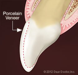 Porcelain Venner Jacksonville, Tx