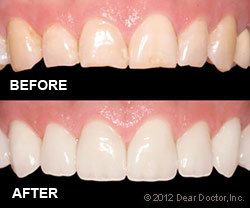 Porcelain Crowns Before and After in in Jacksonville, Texas