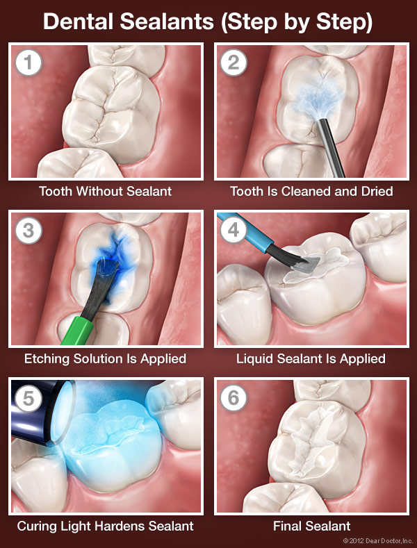 Dental Sealants in Jacksonville, Texas