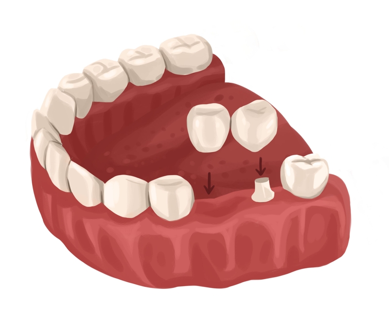 Dental Crown Jacksonville Texas