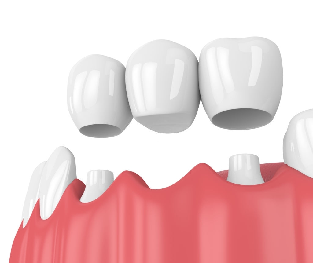 Dental Bridges: What Is It All About?