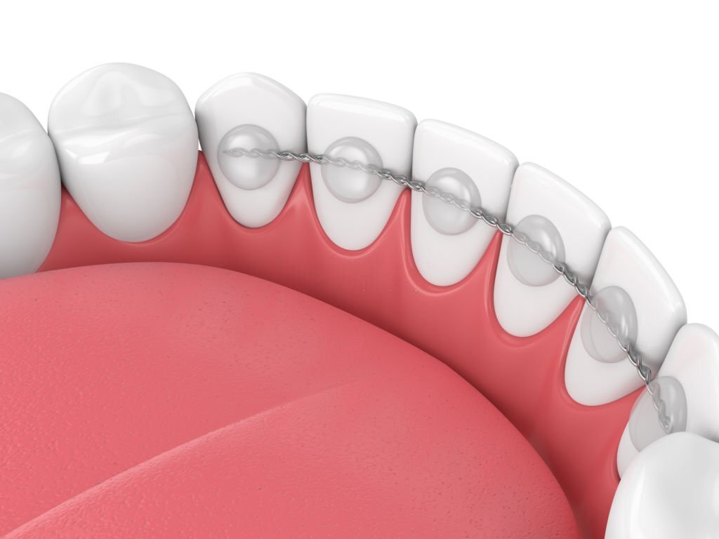 What Makes Dental Bonding A Reliable Option For Your Brighter Smile