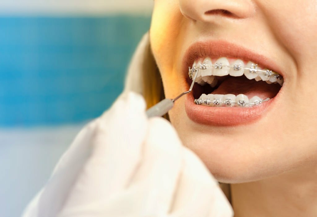 Exploring The Benefits Of Jacksonville Orthodontics