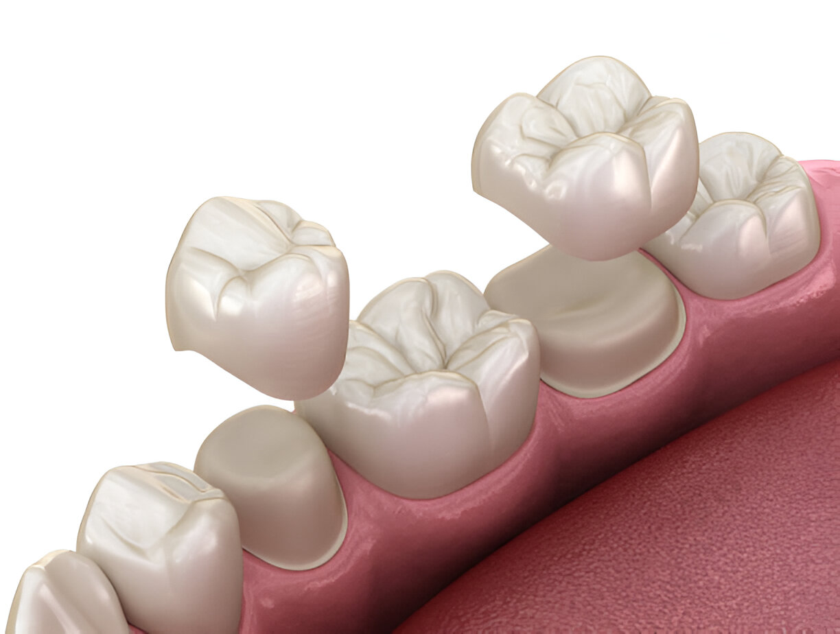 How to Choose the Best Dental Crown for Your Needs_FI